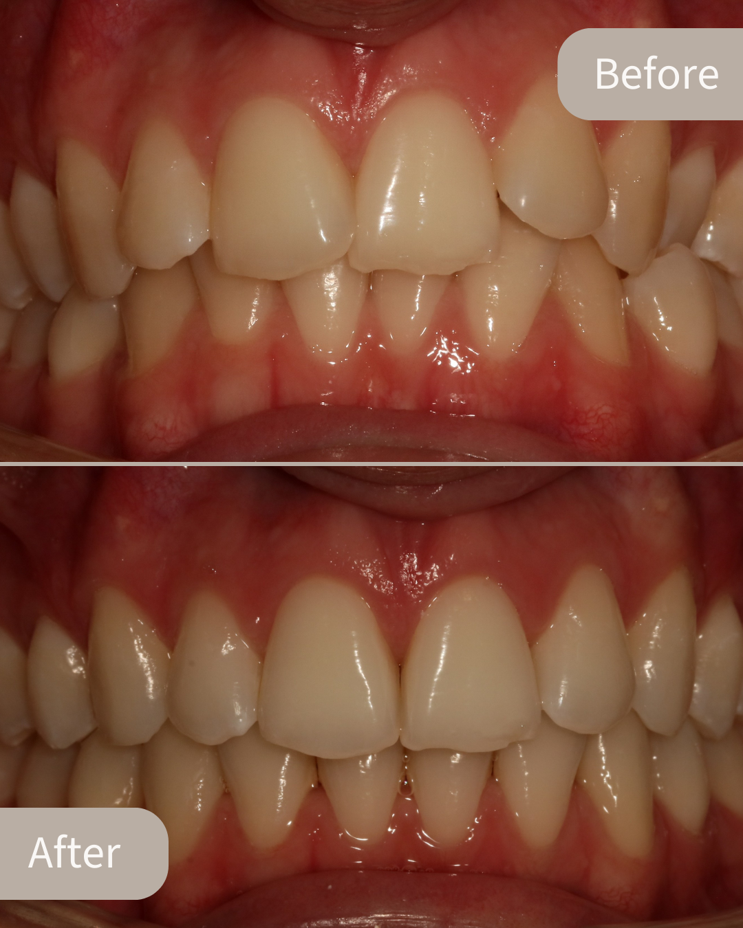 Invisalign® Case 1