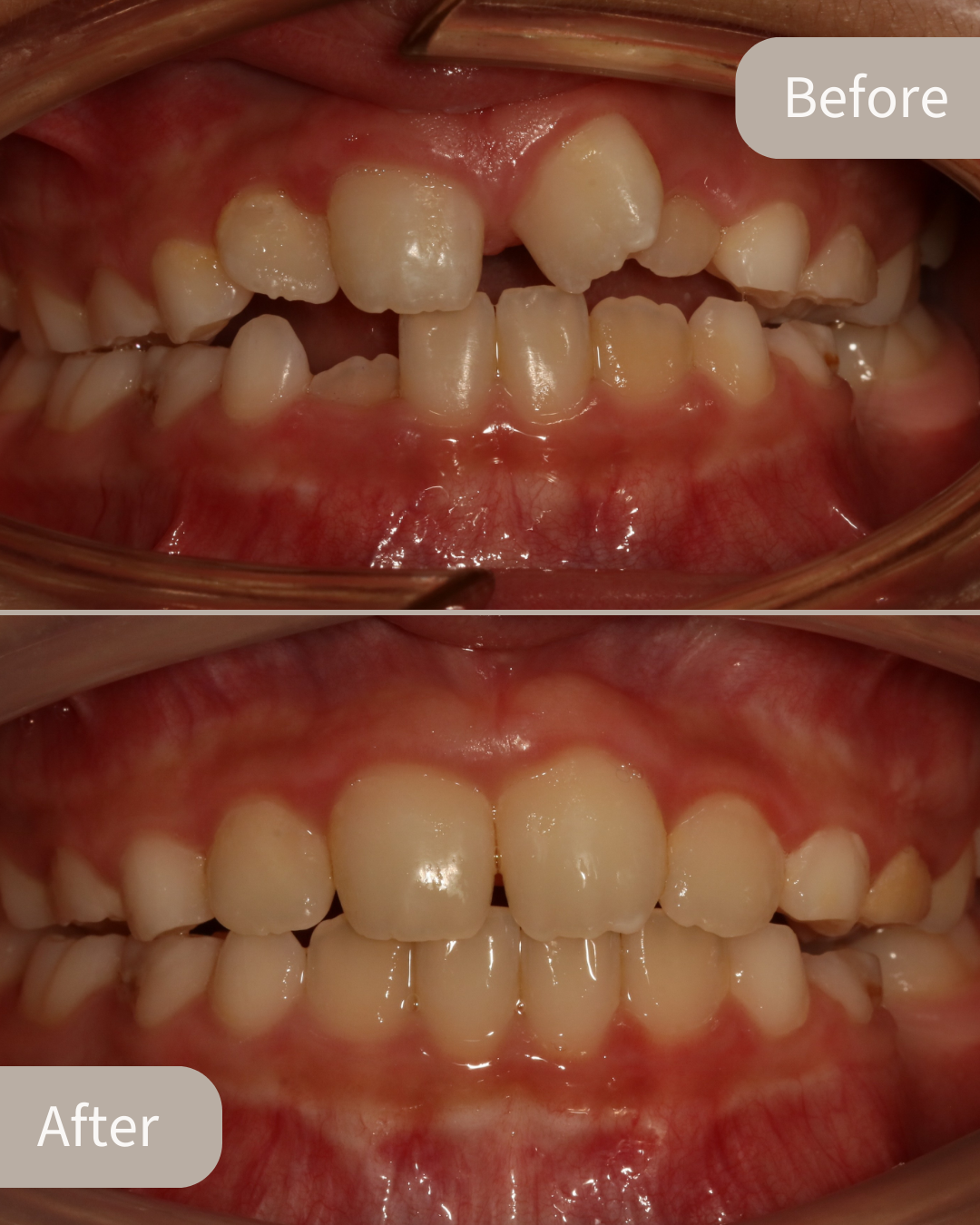 Invisalign® Case 2